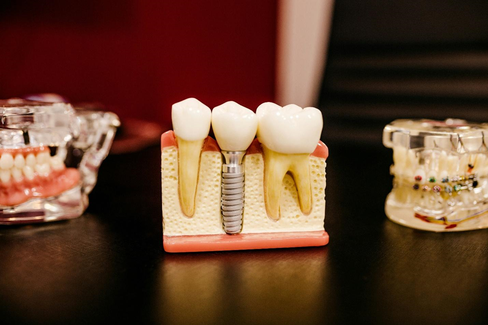 The Different Types of Implants